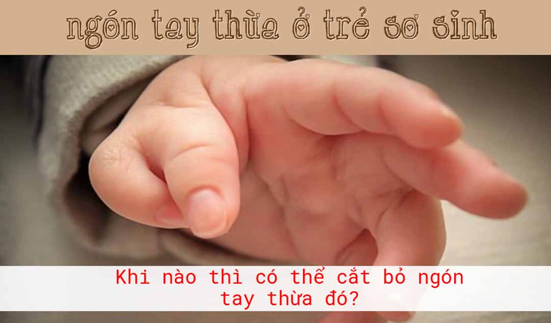 Đứa con mới đẻ của tôi có một ngón tay thừa. Đến bao giờ thì có thể cắt bỏ ngón tay này?