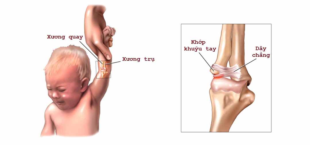 Tôi nắm 2 tay con tôi và nhấc lên, cháu thét lên và một tay cháu không cử động được. Tôi đã làm gì để cháu bị như vậy?