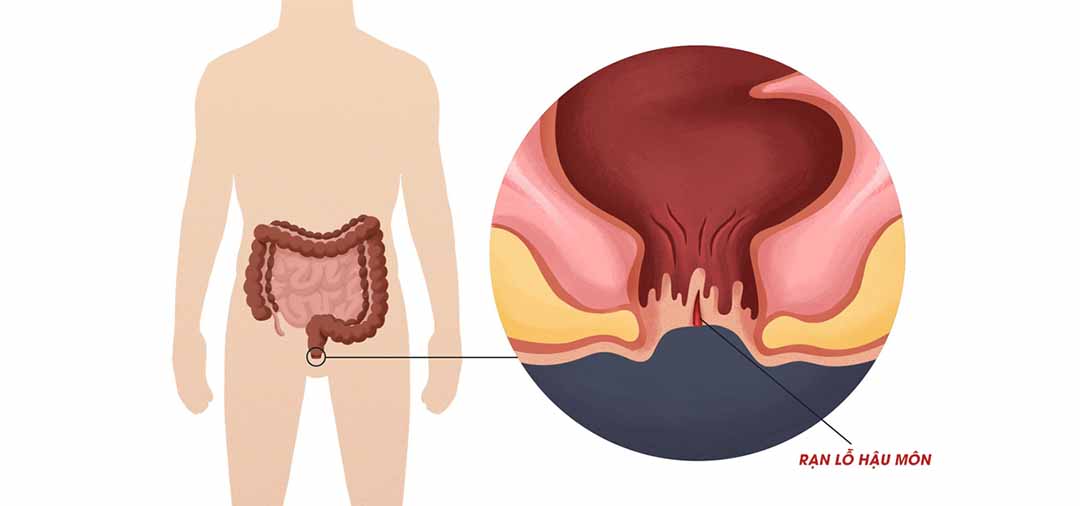 Trong phân của con tôi có các sợi đỏ như máu. Nguyên nhân gây ra hiện tượng đó là gì?