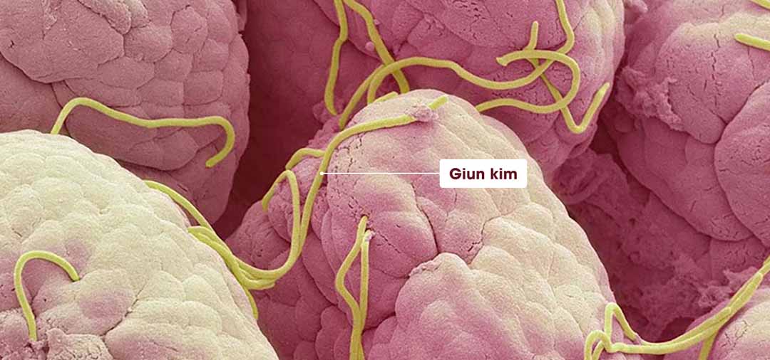 Trong phân đứa con 18 tháng của tôi có những con giun nhỏ li ti như sợi chỉ. Tôi cần phải làm gì?