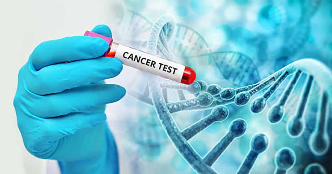 Xét nghiệm Oncotype DX ( còn gọi là kỹ thuật xét nghiệm ung thư vú di truyền) cho bệnh ung thư vú là gì?