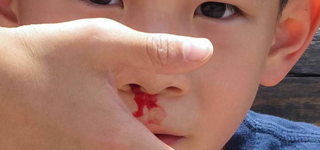 Đứa con 2 tuổi của tôi nhét vào lỗ mũi nó một hạt cườm. Làm thế nào để lấy ra?