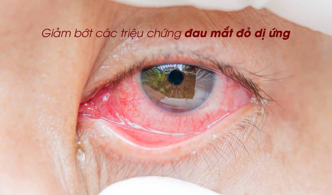 Làm thế nào để giảm bớt các triệu chứng đau mắt đỏ dị ứng?