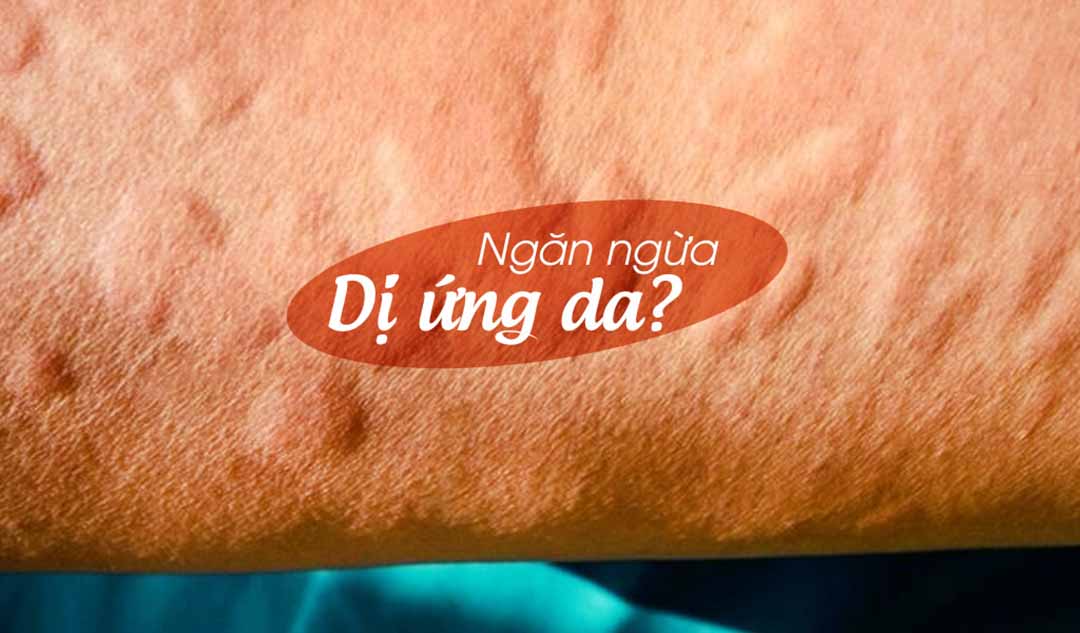 Làm thế nào tôi có thể ngăn ngừa dị ứng da?