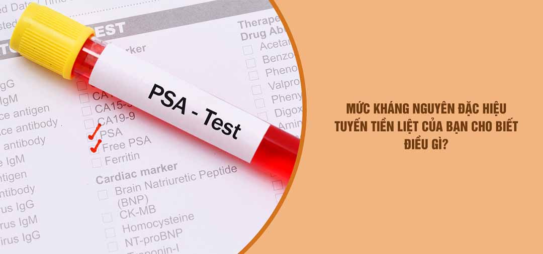 Mức kháng nguyên đặc hiệu tuyến tiền liệt của bạn cho biết điều gì?