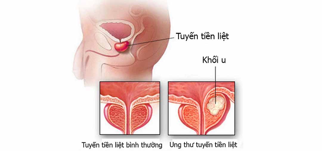 Ung thư tuyến tiền liệt di căn tại chỗ có nghĩa là gì?