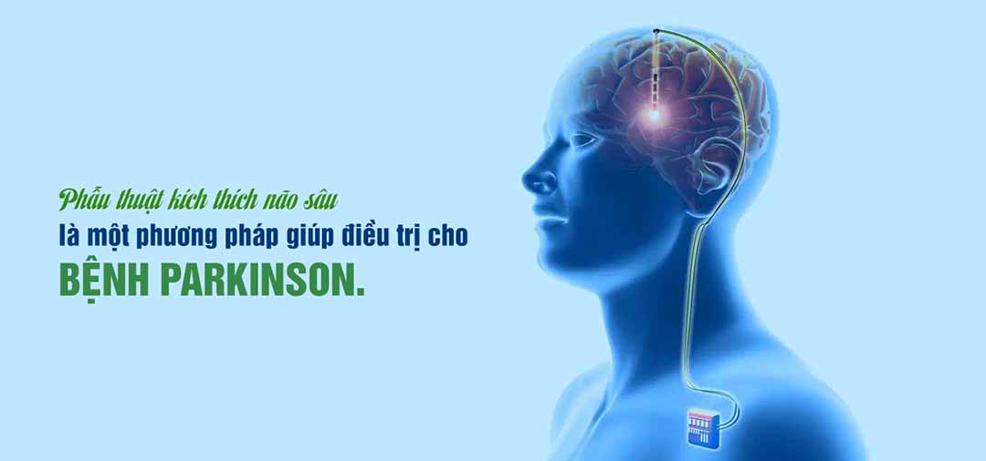 Làm thế nào để phẫu thuật kích thích não sâu cho bệnh Parkinson hoạt động?