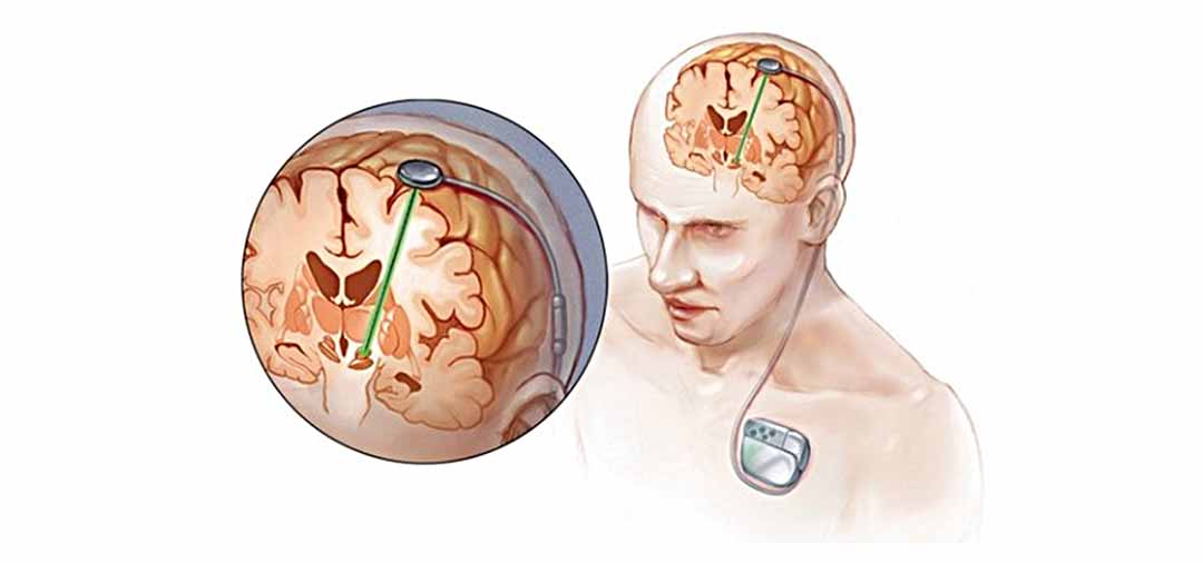 Tôi cần biết gì về phẫu thuật kích thích não sâu đối với bệnh Parkinson?