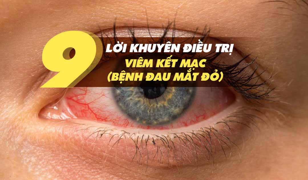 Những lời khuyên khác để điều trị viêm kết mạc (bệnh đau mắt đỏ) là gì?