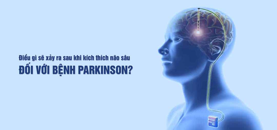  Điều gì sẽ xảy ra sau khi kích thích não sâu đối với bệnh Parkinson?