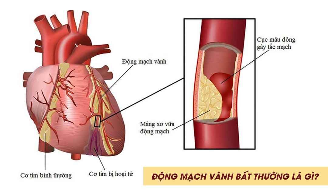 Động mạch vành bất thường là gì?