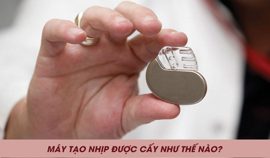 Máy tạo nhịp được cấy như thế nào?