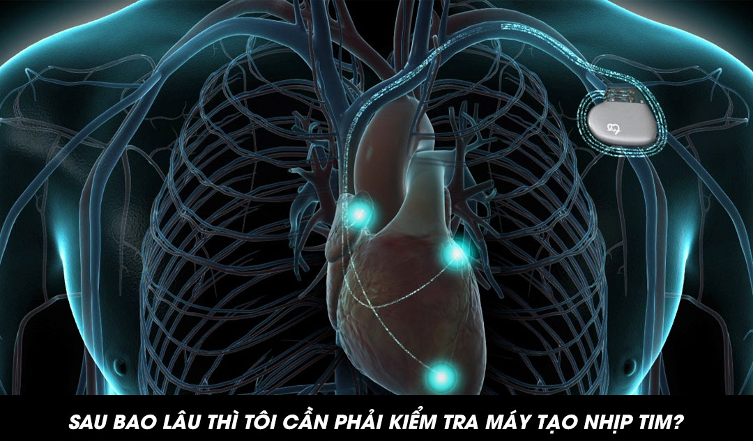 Sau bao lâu thì tôi cần phải kiểm tra máy tạo nhịp tim?