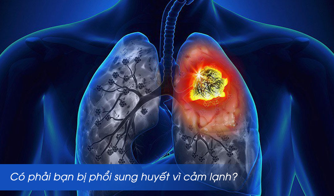 Có phải bạn bị phổi sung huyết vì cảm lạnh?