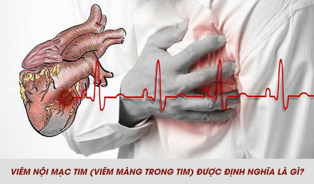 Viêm nội mạc tim (viêm màng trong tim) được định nghĩa là gì?