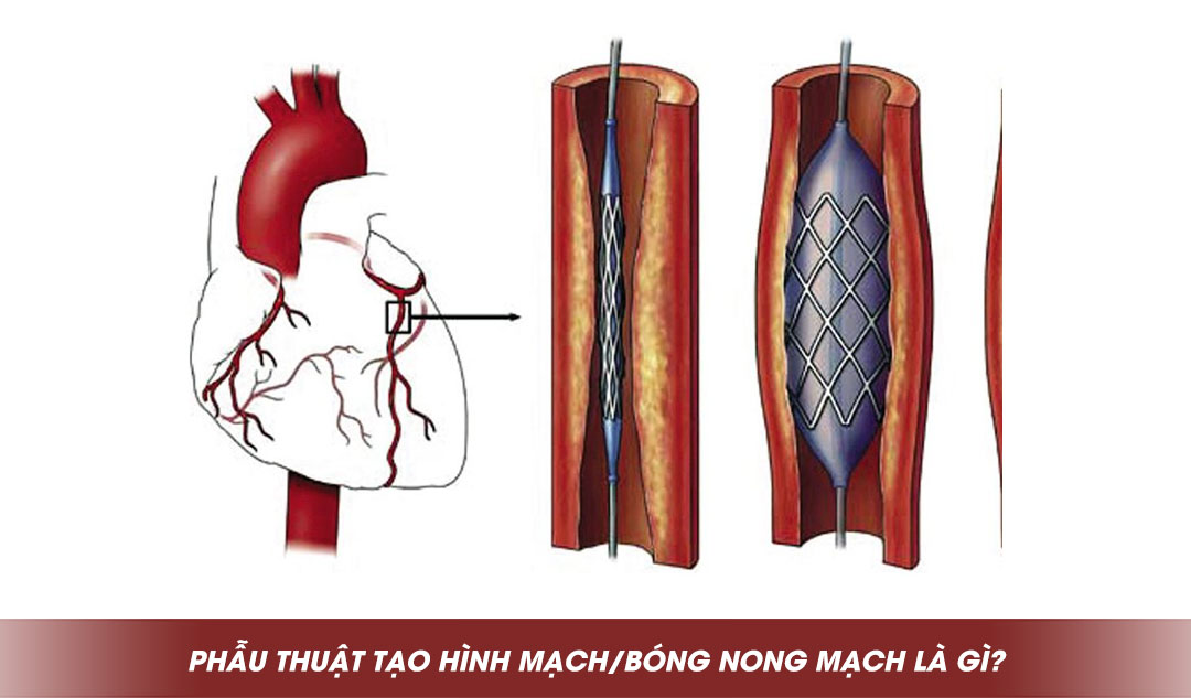 Phẫu thuật tạo hình mạch/bóng nong mạch là gì?