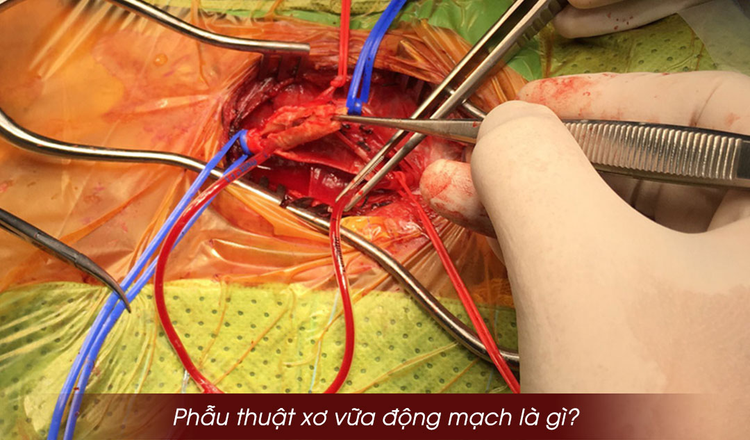 Phẫu thuật xơ vữa động mạch là gì?