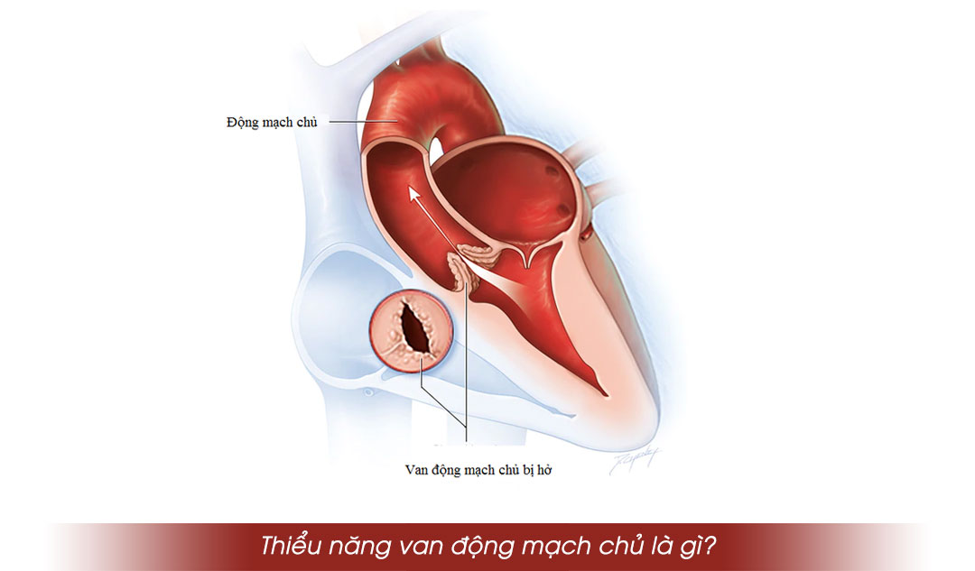 Thiểu năng van động mạch chủ là gì?