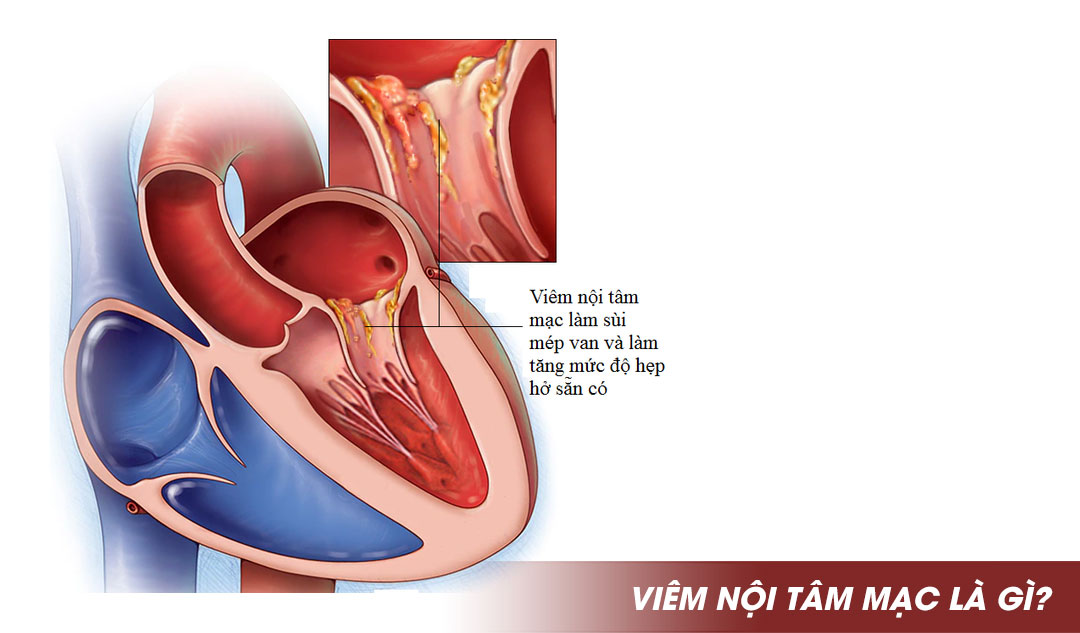 Viêm nội tâm mạc là gì?