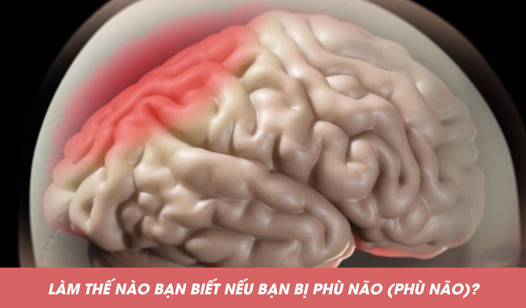  Làm thế nào bạn biết nếu bạn bị phù não (phù não)?