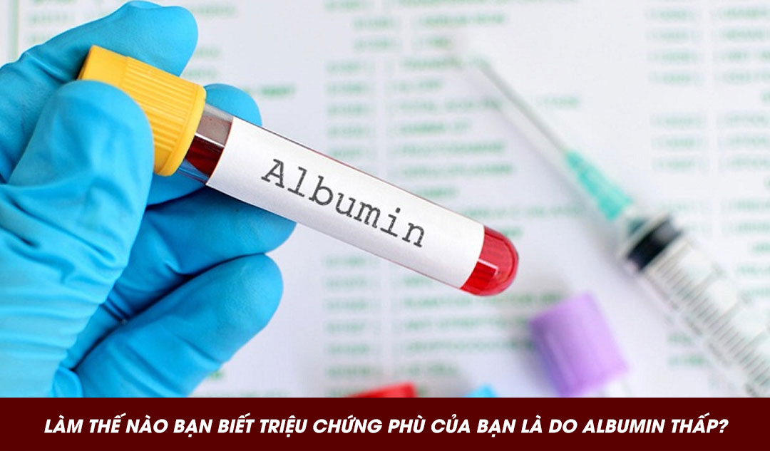  Làm thế nào bạn biết triệu chứng phù của bạn là do albumin thấp?