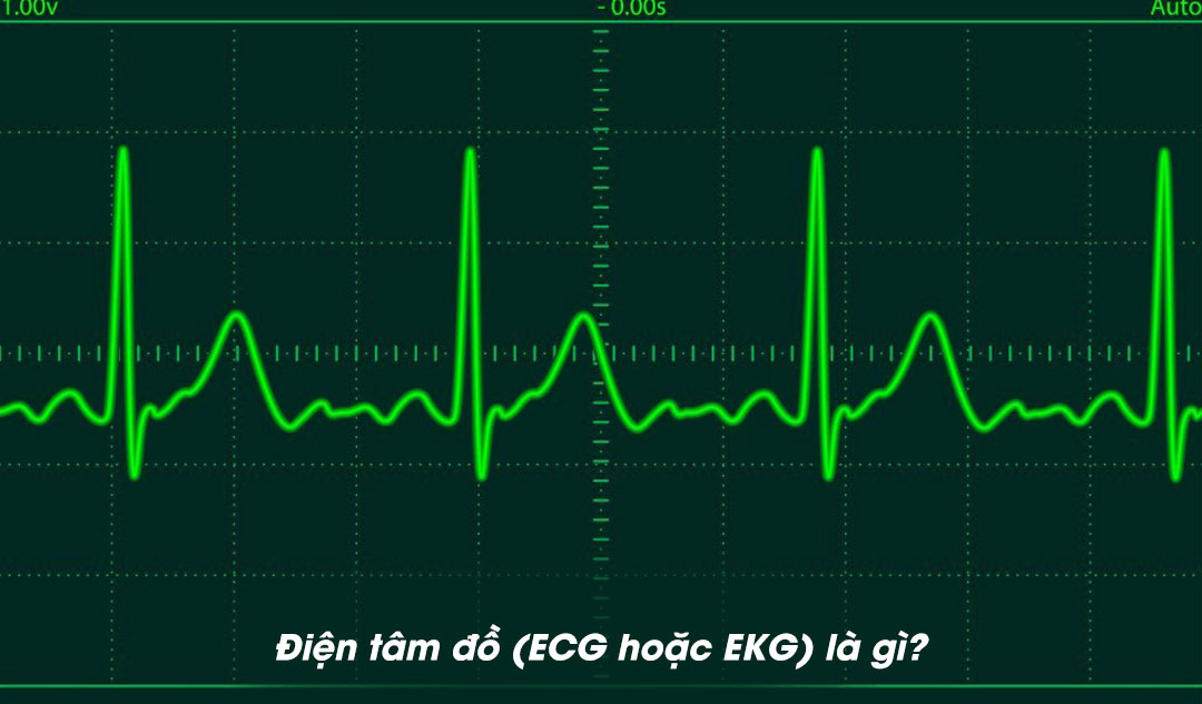 Điện tâm đồ (ECG hoặc EKG) là gì?