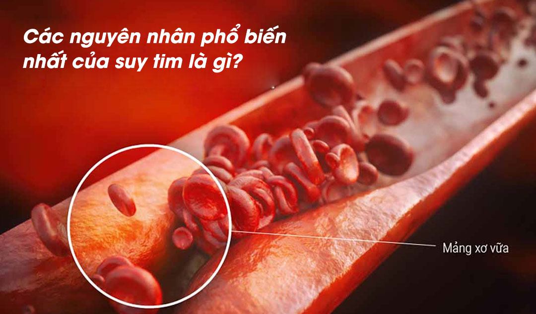 Các nguyên nhân phổ biến nhất của suy tim là gì?