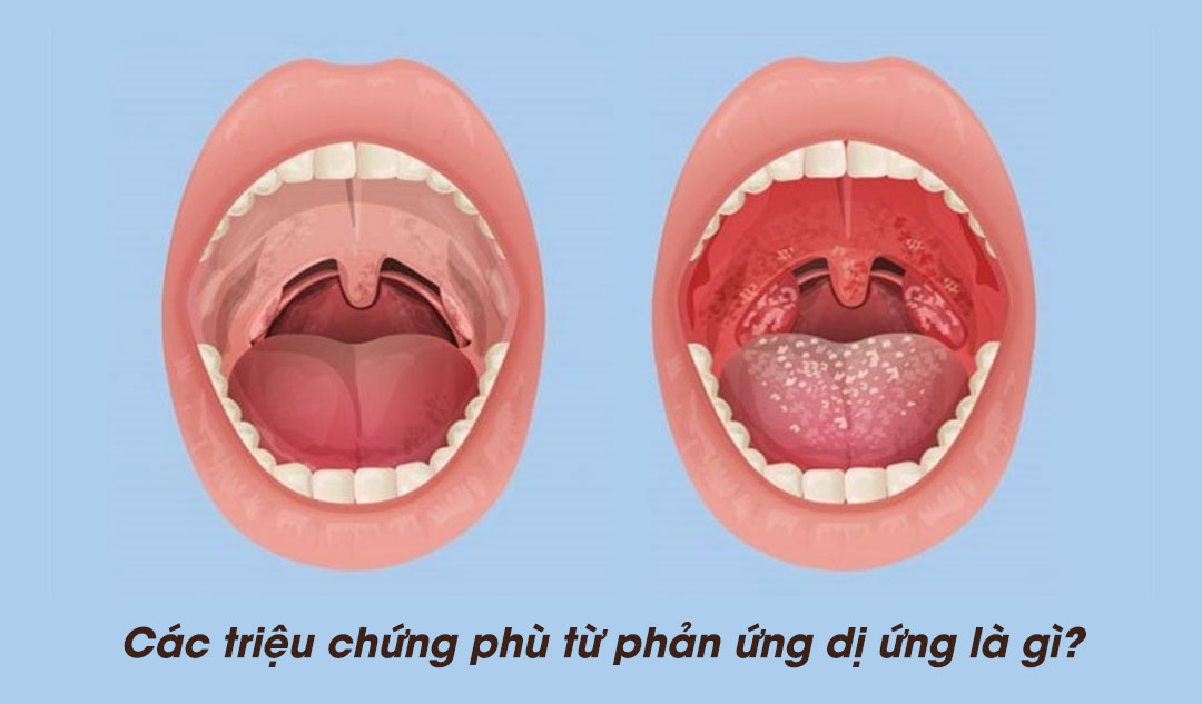 Các triệu chứng phù từ phản ứng dị ứng là gì?