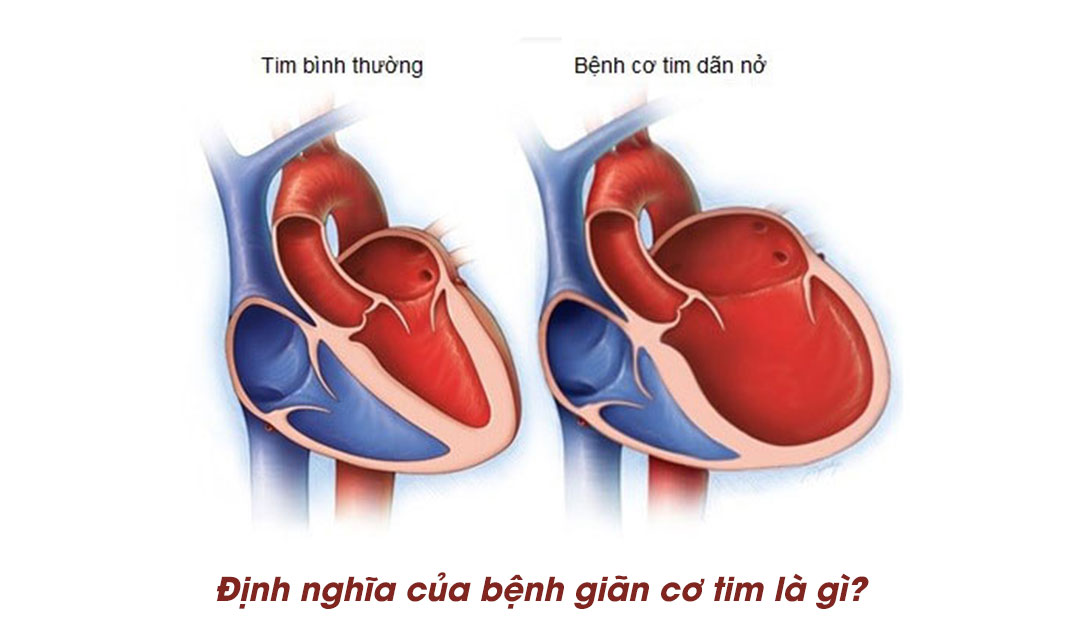 Định nghĩa của bệnh giãn cơ tim là gì?