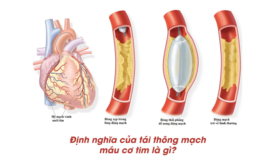  Định nghĩa của tái thông mạch máu cơ tim là gì?