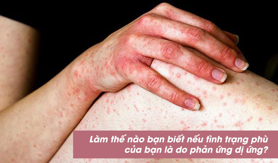 Làm thế nào bạn biết nếu tình trạng phù của bạn là do phản ứng dị ứng?