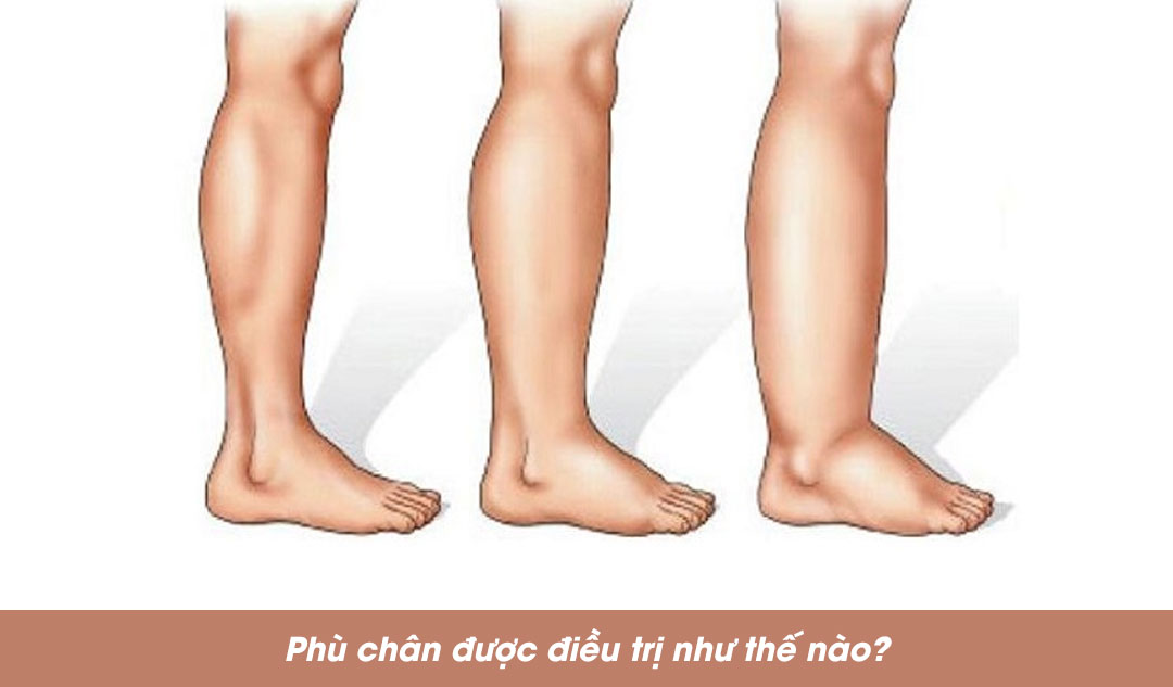  Phù chân được điều trị như thế nào?