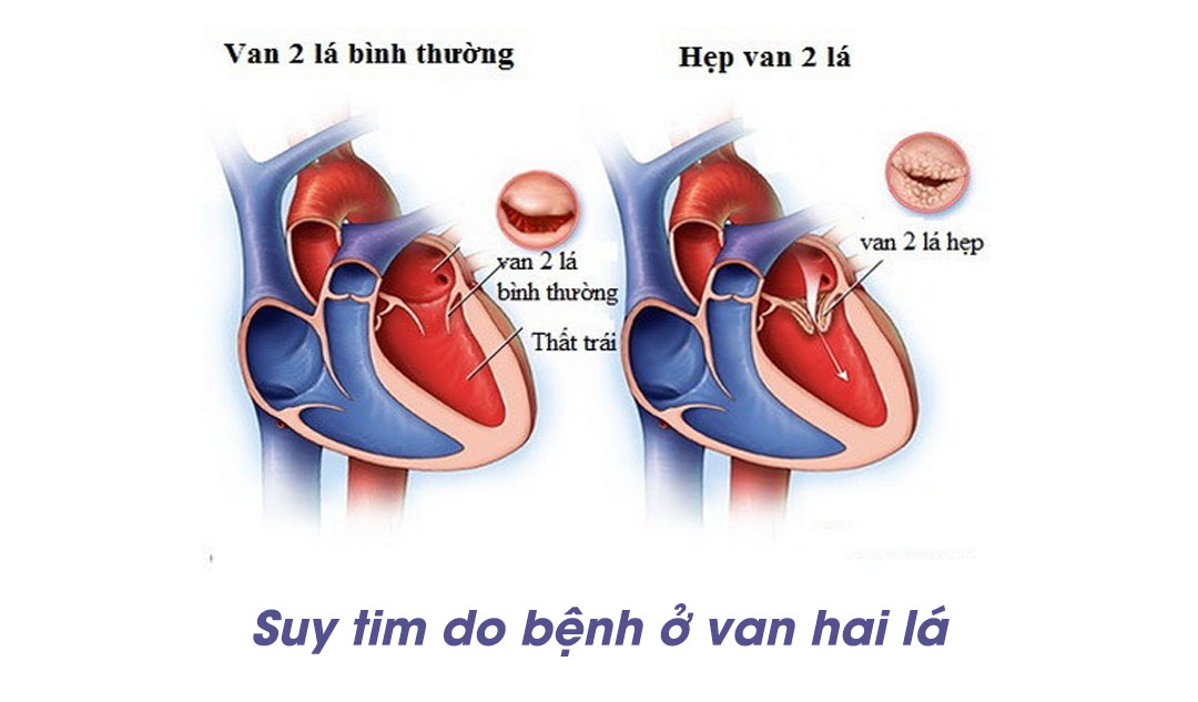 Suy tim do bệnh ở van hai lá