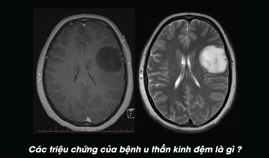 Các triệu chứng của bệnh u thần kinh đệm là gì ?