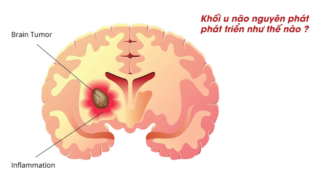 Khối u não nguyên phát phát triển như thế nào ?