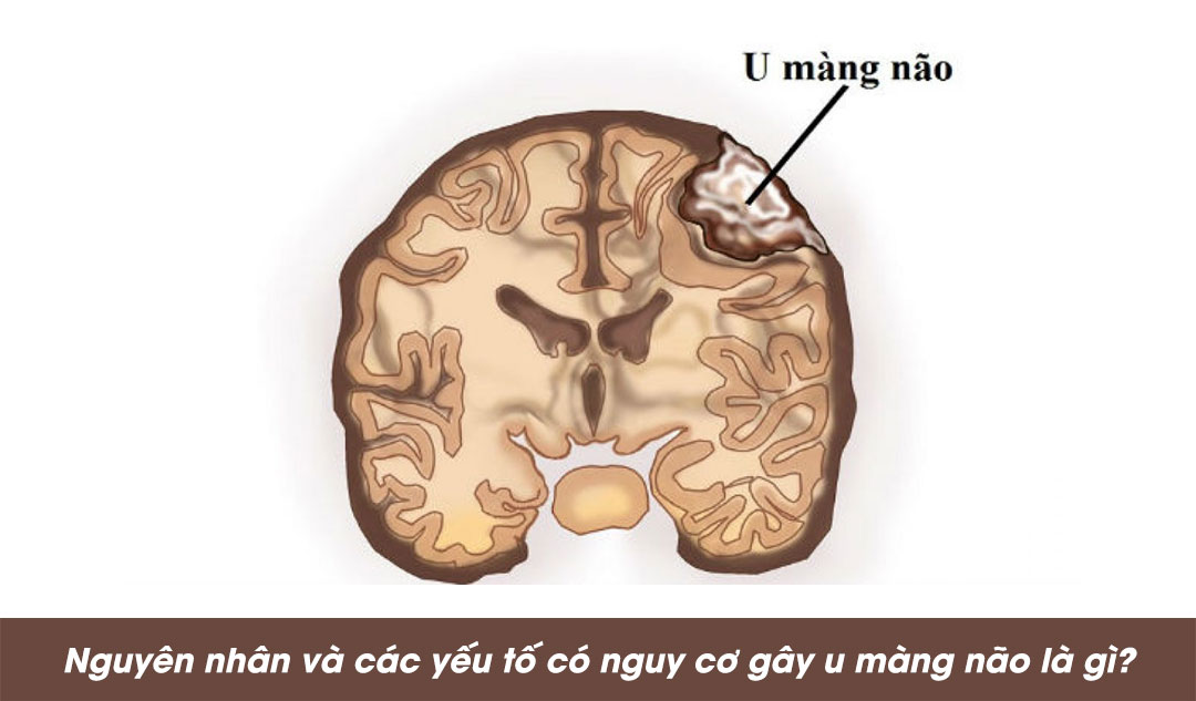 Nguyên nhân và các yếu tố có nguy cơ gây u màng não là gì?