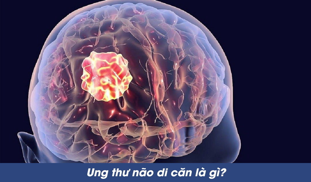 Ung thư não di căn là gì?