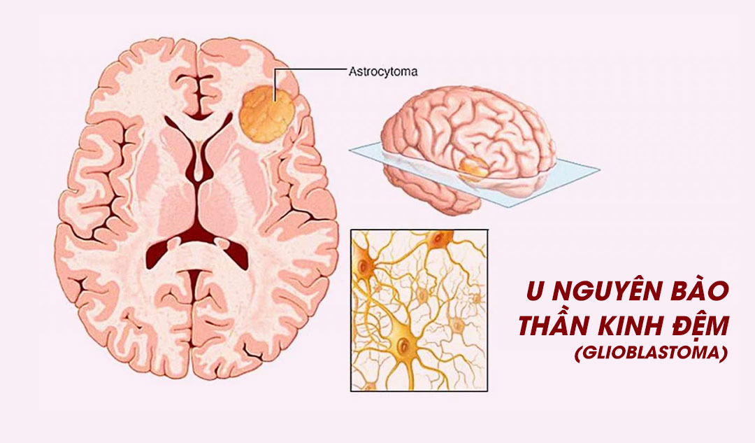 U nguyên bào thần kinh đệm (glioblastoma) được hình thành ở đâu trong bộ não ?