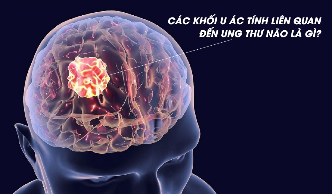 Các khối u ác tính liên quan đến ung thư não là gì?