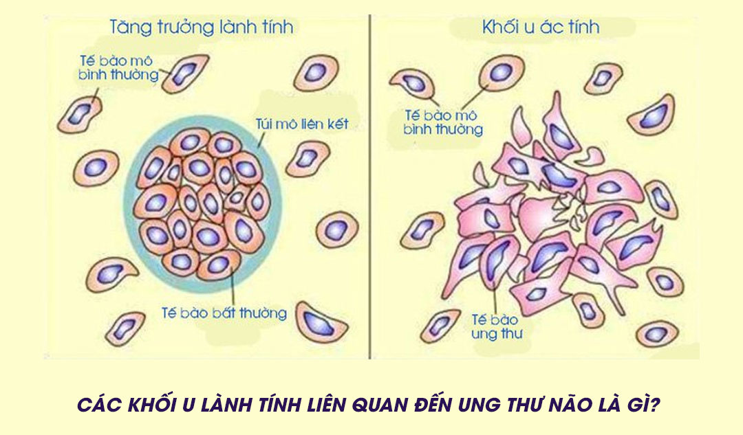 Các khối u lành tính liên quan đến ung thư não là gì?