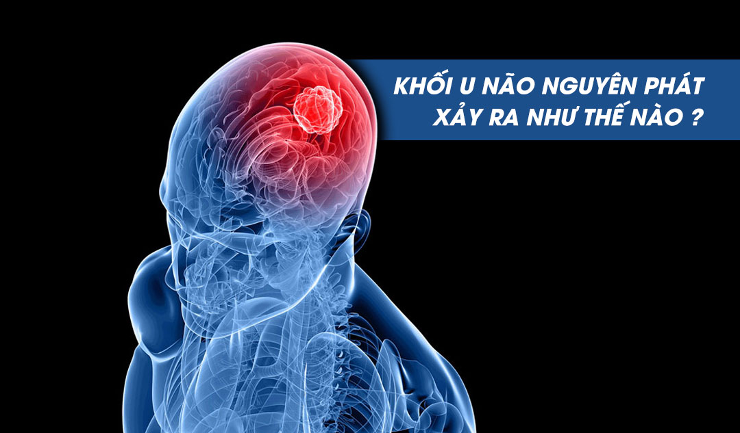 Khối u não nguyên phát xảy ra như thế nào ?