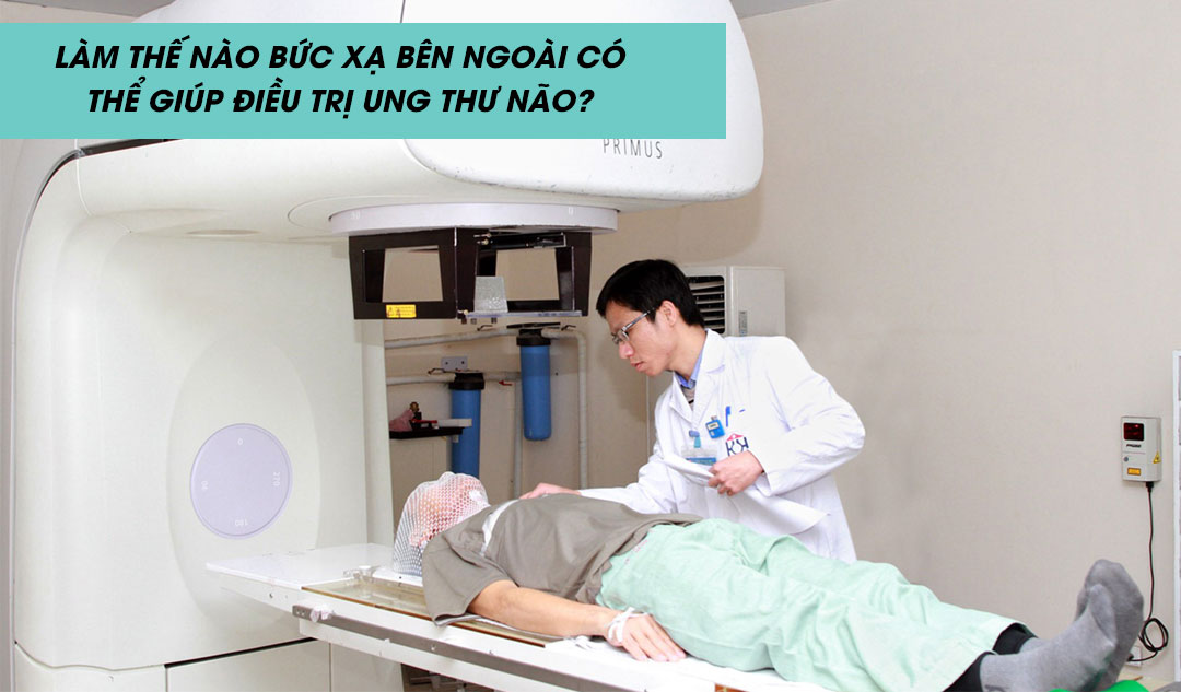 Làm thế nào bức xạ bên ngoài có thể giúp điều trị ung thư não?