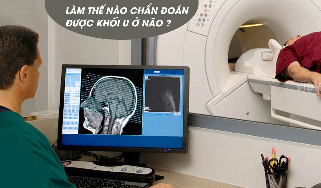 Làm thế nào chẩn đoán được khối u ở não ?