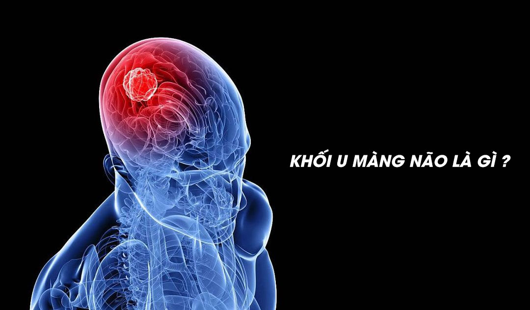 Khối u màng não là gì ?