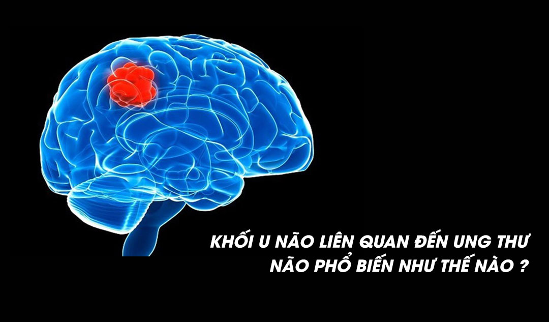 Khối u não liên quan đến ung thư não phổ biến như thế nào ?