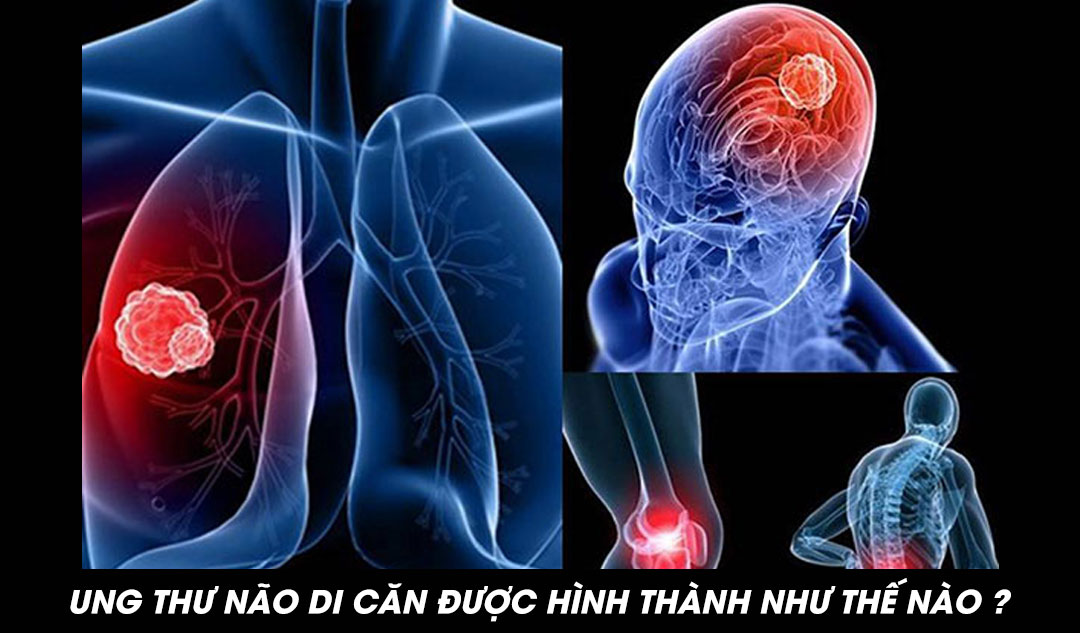 Ung thư não di căn được hình thành như thế nào ?