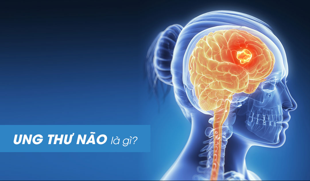 Ung thư não là gì ?