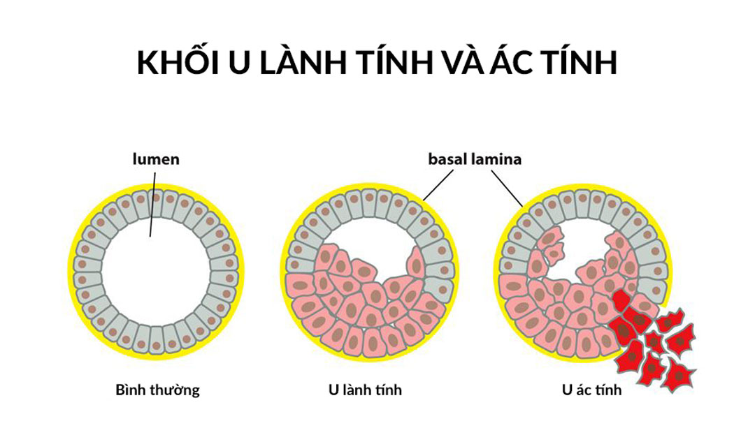 Sự khác biệt giữa các khối u não lành tính và ác tính là gì?