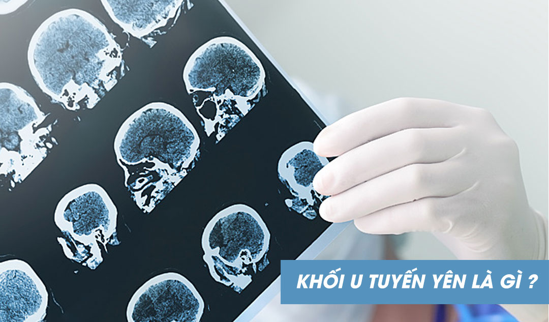 Khối u tuyến yên là gì ?