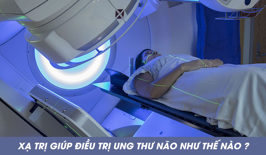 Xạ trị giúp điều trị ung thư não như thế nào ?